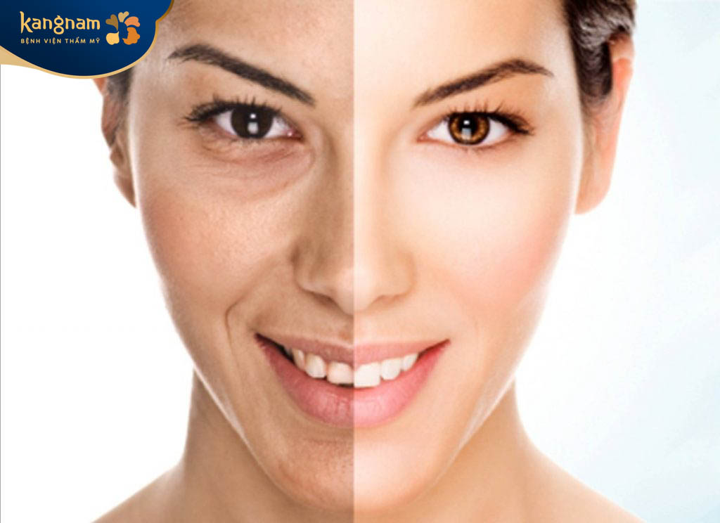 Tiêm filler rãnh cười: Nguy cơ tiềm ẩn và cách phòng ngừa