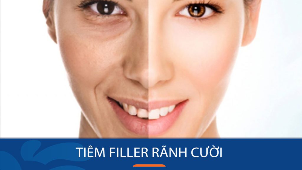 Tiêm filler rãnh cười: Bí quyết xóa mờ nếp nhăn, trẻ hóa da mặt