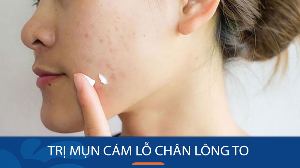 Bí quyết đánh bay mụn cám, se khít lỗ chân lông, lấy lại làn da sáng mịn chỉ trong 7 ngày