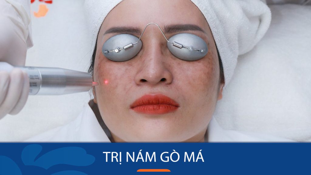 Bí quyết Đánh Bay Nám Gò Má Vĩnh Viễn Chỉ Trong 7 Ngày