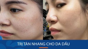 18 Cách Trị tàn nhang cho da dầu không gây nhờn rít