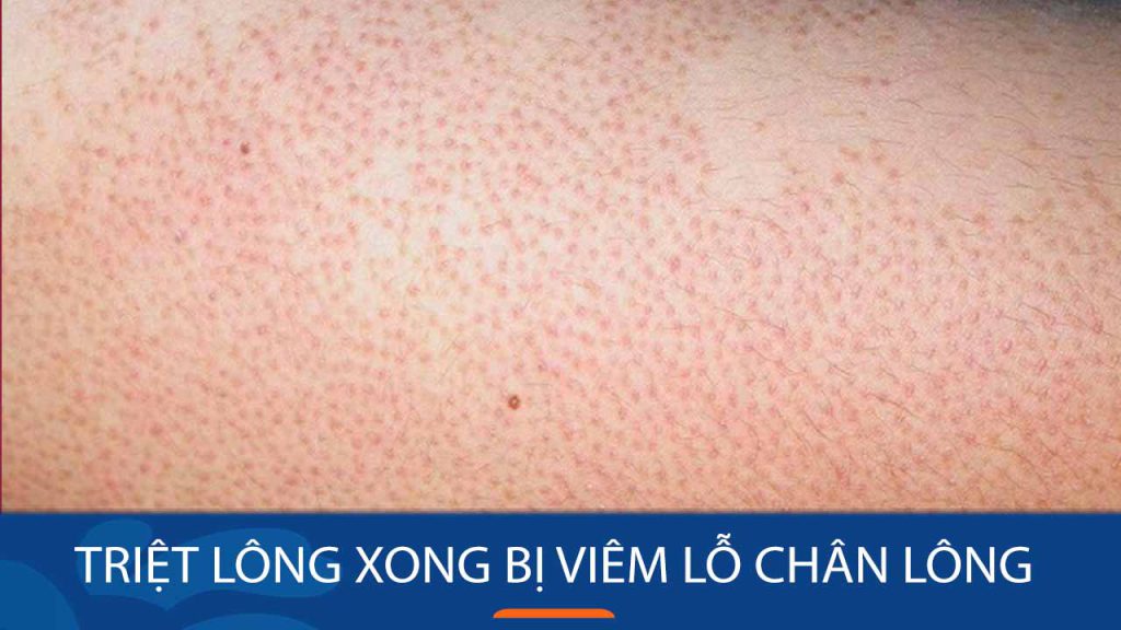 Triệt Lông Xong Bị Viêm Lỗ Chân Lông: Nguyên Nhân & Bí Quyết Điều Trị