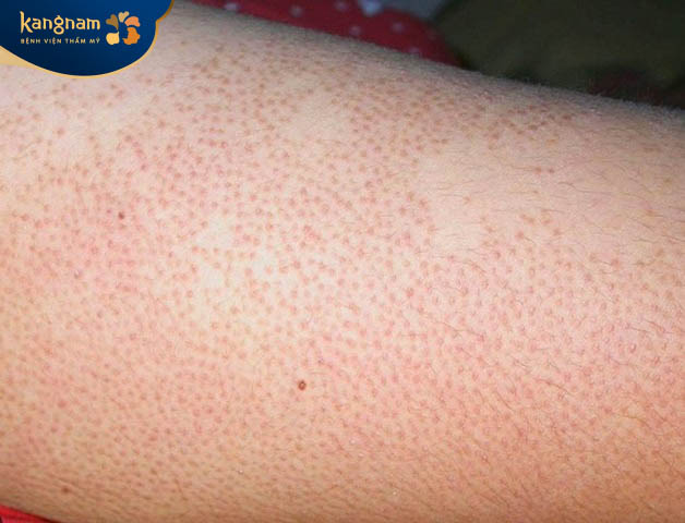 Có nhiều nguyên nhân gây viêm lỗ chân lông sau triệt lông