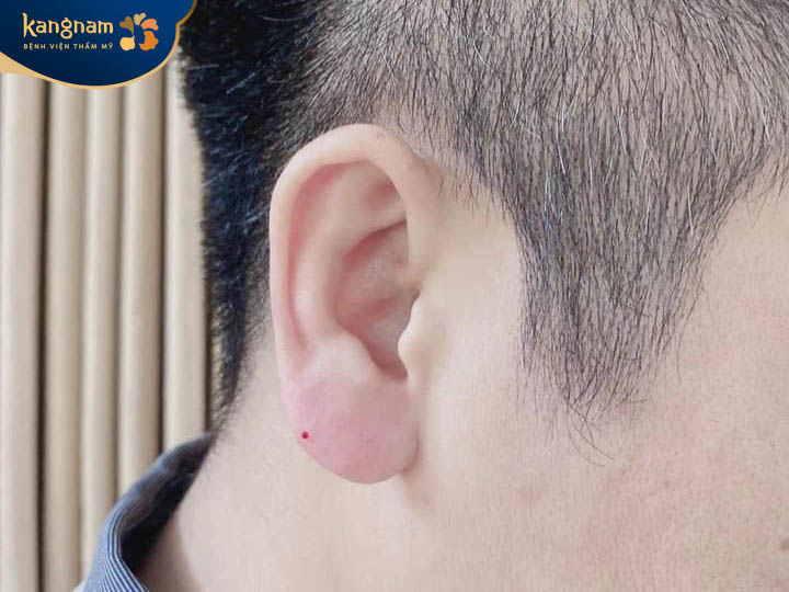 Rất nhiều nam giới lựa chọn tiêm filler để sở hữu dáng tai phật