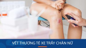 Cách xử lý vết thương té xe trầy chân nữ không để lại sẹo