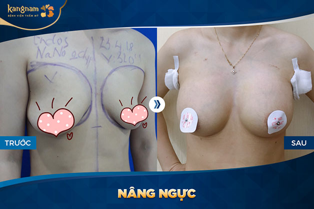 Kết quả khách hàng nâng ngực tại Kangnam không còn"vú mướp" và không để lại sẹo 
