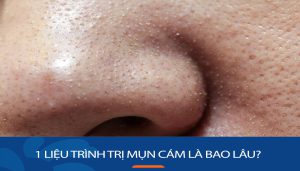 1 Liệu trình trị mụn cám là bao lâu?  Bí Quyết Rút Ngắn Thời Gian