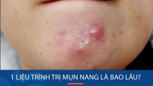 1 Liệu trình trị mụn nang là bao lâu?Bác sĩ giải đáp