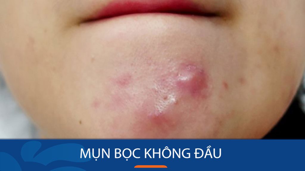 Mụn Bọc Không Đầu – Loại Bỏ Dứt Điểm Chỉ Trong 7 Ngày