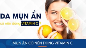 [Giải đáp] Mụn ẩn có nên dùng vitamin C? Bí quyết sử dụng hiệu quả