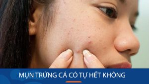 Mụn trứng cá có tự hết không? Bí quyết đánh bay mụn trứng cá hiệu quả