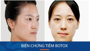 5 Biến chứng tiêm botox MÀ AI CŨNG CẦN BIẾT trước khi làm đẹp