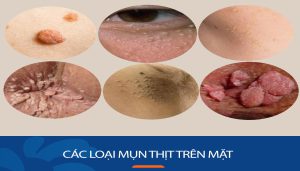 Các loại mụn thịt trên mặt, Cách nhận biết dễ dàng