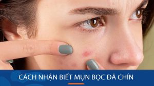 Cách nhận biết mụn bọc chín chuẩn xác – Giải pháp từ chuyên gia da liễu