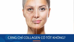 Căng chỉ collagen có tốt không? Chuyên gia Kangnam giải đáp