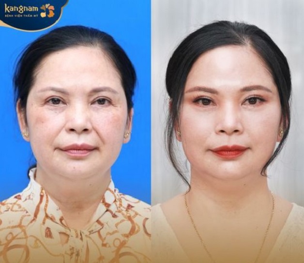 Cô Thu - 52 tuổi trẻ hóa làn da với công nghệ Mi Young