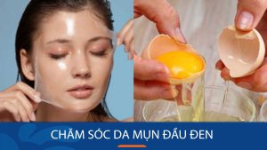 7 Bí quyết “Đánh bay” Mụn đầu đen Chỉ Trong 7 Ngày