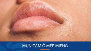 Mụn cám quanh miệng – Nỗi ám ảnh của mọi cô gái: Cách trị hiệu quả tại nhà