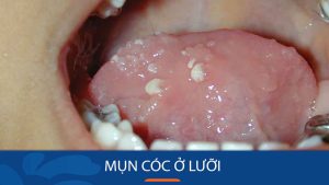 Mụn cóc ở lưỡi: Dấu hiệu nhận biết và cách chữa trị