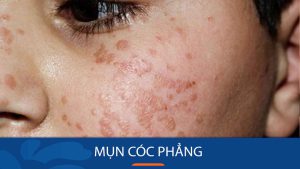 Mụn cóc phẳng: Giải mã nguyên nhân, triệu chứng và cách trị dứt điểm