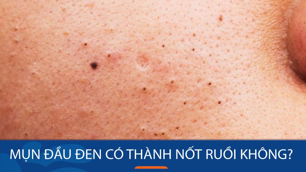 Mụn đầu đen có thành nốt ruồi? Bí quyết loại bỏ tận gốc