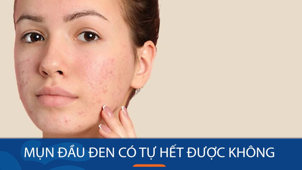 Mụn đầu đen có tự hết được không? Bí quyết loại bỏ mụn hiệu quả