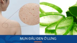 Mụn đầu đen ở lưng: 7 bí quyết đánh bay hoàn toàn tại nhà