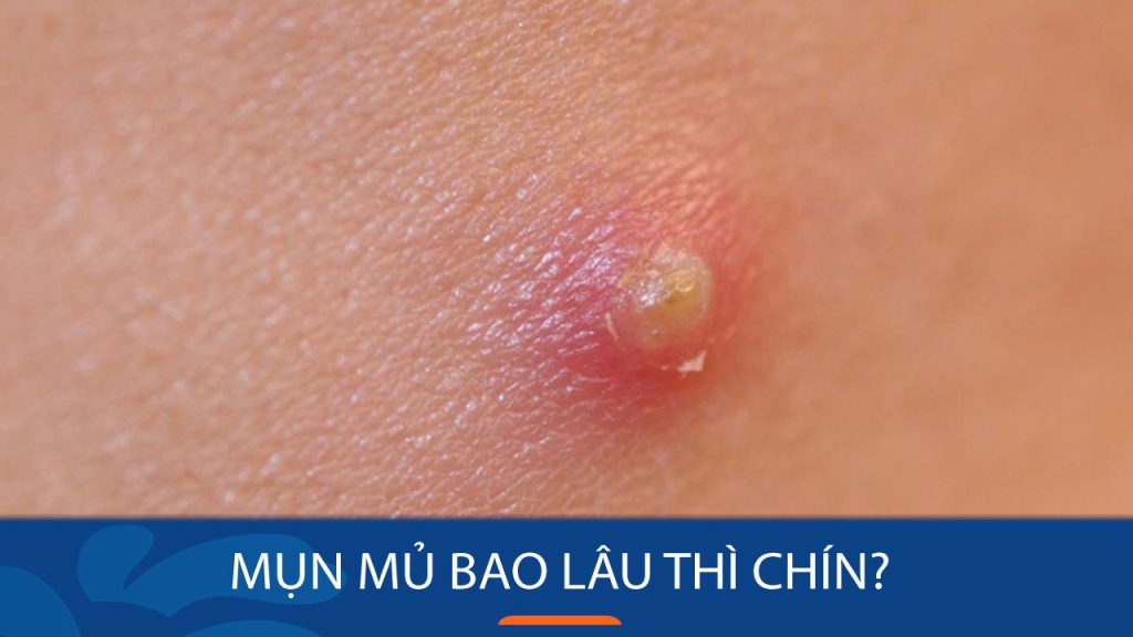 Mụn mủ bao lâu thì chín? Vòng đời của mụn mủ: Hiểu rõ để điều trị hiệu quả