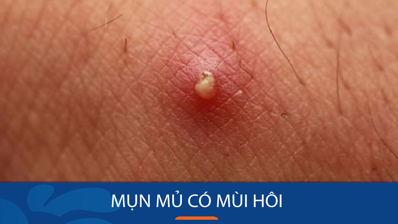 Mụn mủ có mùi hôi Dấu hiệu cảnh báo và cách điều trị kịp thời