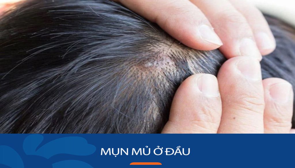 Mụn mủ trên đầu:Bí quyết trị dứt điểm mụn mủ trên đầu chỉ trong 7 ngày