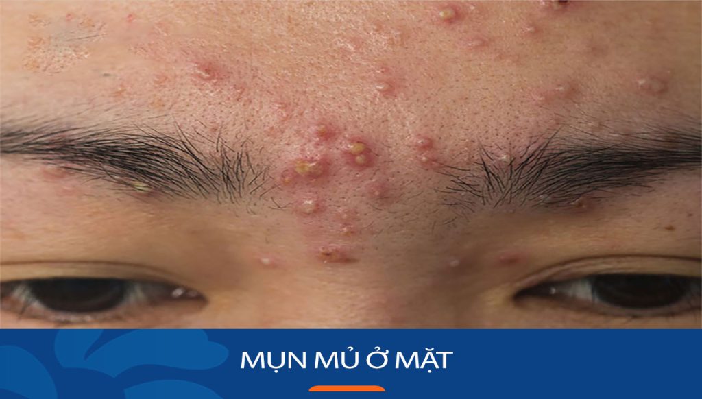 Mụn mủ ở mặt: Cách trị mụn mủ ở mặt hiệu quả NHẤT trong 7 ngày