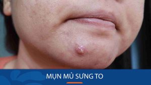 Bí quyết loại bỏ mụn mủ sưng to nhanh chóng và an toàn