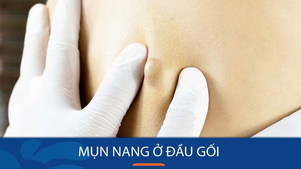 Mụn nang ở đầu gối: Nguyên nhân, triệu chứng và cách điều trị