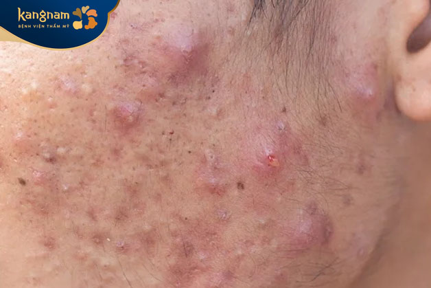 Mụn viêm thường không nguy hiểm đến sức khỏe, nhưng ảnh hưởng đến làn da