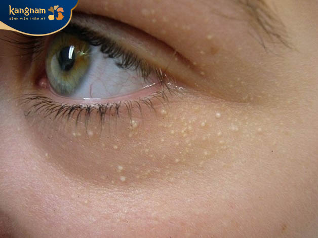 Mụn thịt khóe mắt có gây nguy hiểm đến sức khỏe không