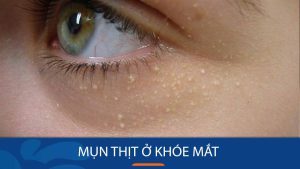 Mụn thịt ở khóe mắt: Cách loại bỏ mụn thịt ở khóe mắt hiệu quả