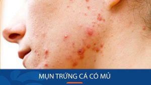 Cách trị mụn trứng cá có mủ NHANH NHANH chỉ trong 3 ngày