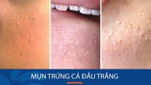 10 Cách Loại Bỏ Mụn Trứng Cá Đầu Trắng Hiệu Quả Tại Nhà