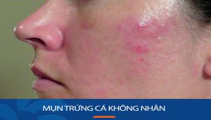 Mụn trứng cá không nhân: Bí quyết loại bỏ hoàn toàn