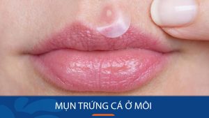 Cách trị mụn trứng cá quanh môi hiệu quả trong 7 ngày