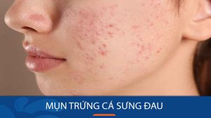 Cách trị mụn trứng cá sưng đau nhanh chóng và hiệu quả chỉ trong 1 đêm