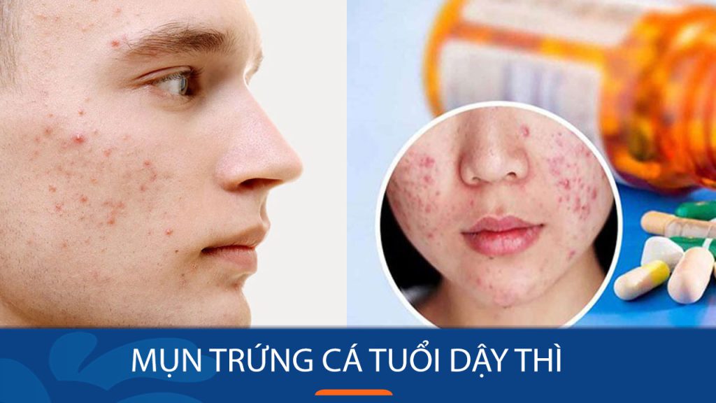 Mụn trứng cá tuổi dậy thì? những lưu ý khi bị mụn