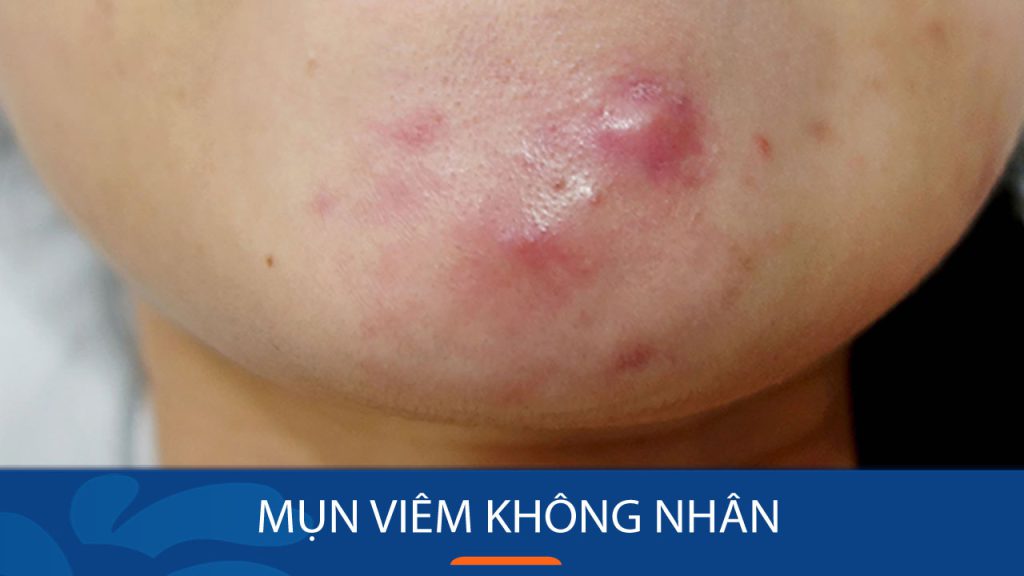 Bí quyết loại bỏ mụn viêm không nhân dứt điểm không nhân tái phát?