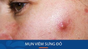 Mụn viêm sưng đỏ: Cách điều trị tận gốc