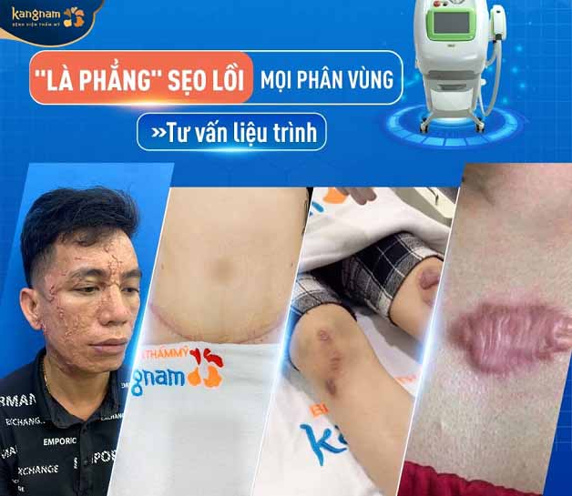 Điều trị dứt điểm sẹo lồi công nghệ ELLA tại Kangnam