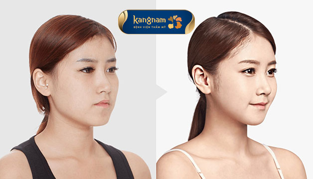 Tiêm botox phù hợp với những ai có phần cơ phù đại 