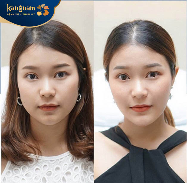 Bạn Hoàng Anh - (27 tuổi - Ba Đình) cảm thấy hài lòng sau tiêm botox tại Kangnam