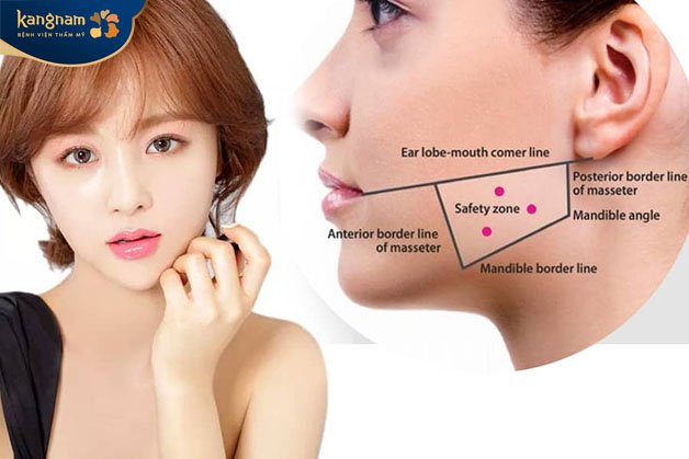 Phần hàm bị sưng có thể do cơ địa hoặc botox sử dụng chất lượng kém 