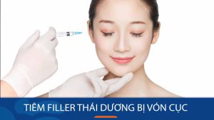 Tiêm filler thái dương bị vón cục: Nguyên nhân và cách khắc phục