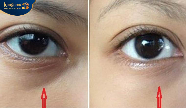 Hiệu quả trị thâm mắt được duy trì từ 6 - 36 tháng